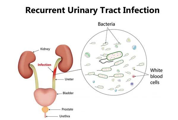 UTI