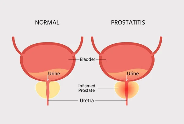 Prostate Enlargement and Carcinoma Prostate